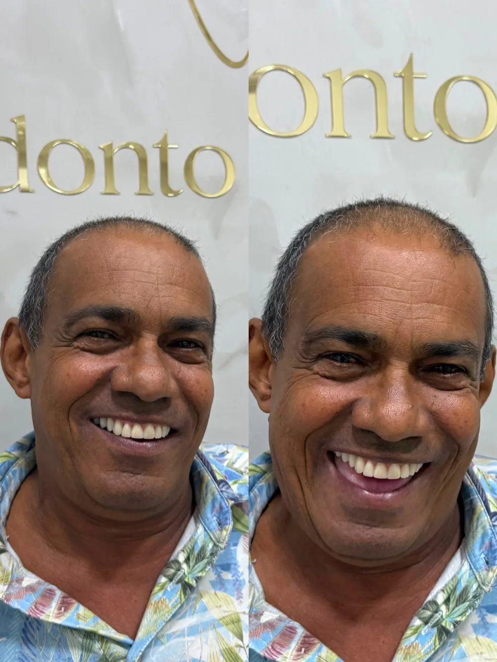 Antes e depois de paciente reabilitado com dentes fixos na Odonto Concept