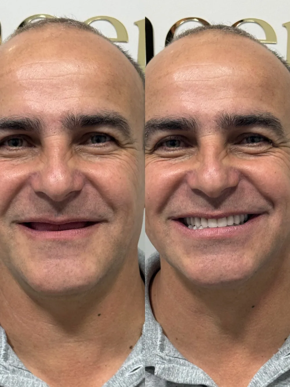 Resultado de reabilitação do sorriso na Odonto Concept