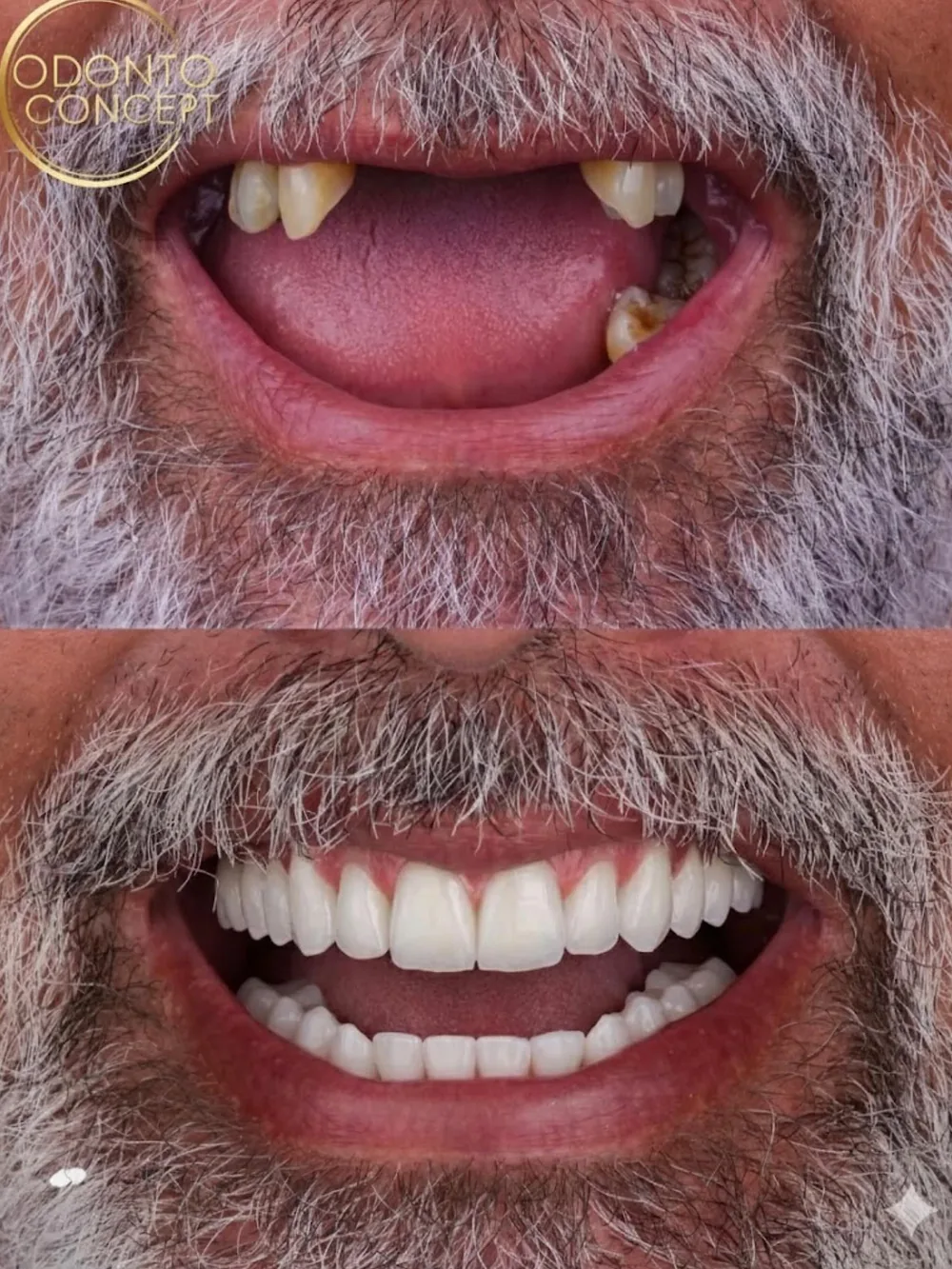 Antes e depois da arcada de um paciente com prótese fixa sobre implantes